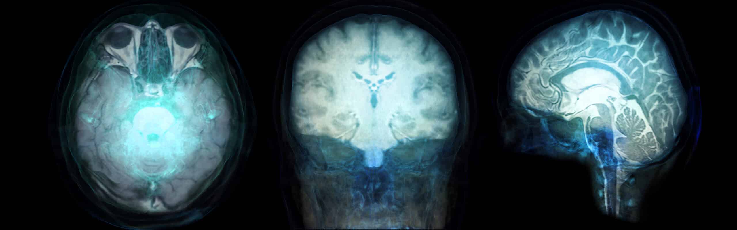 3 fMRI scans of the human brain on black background